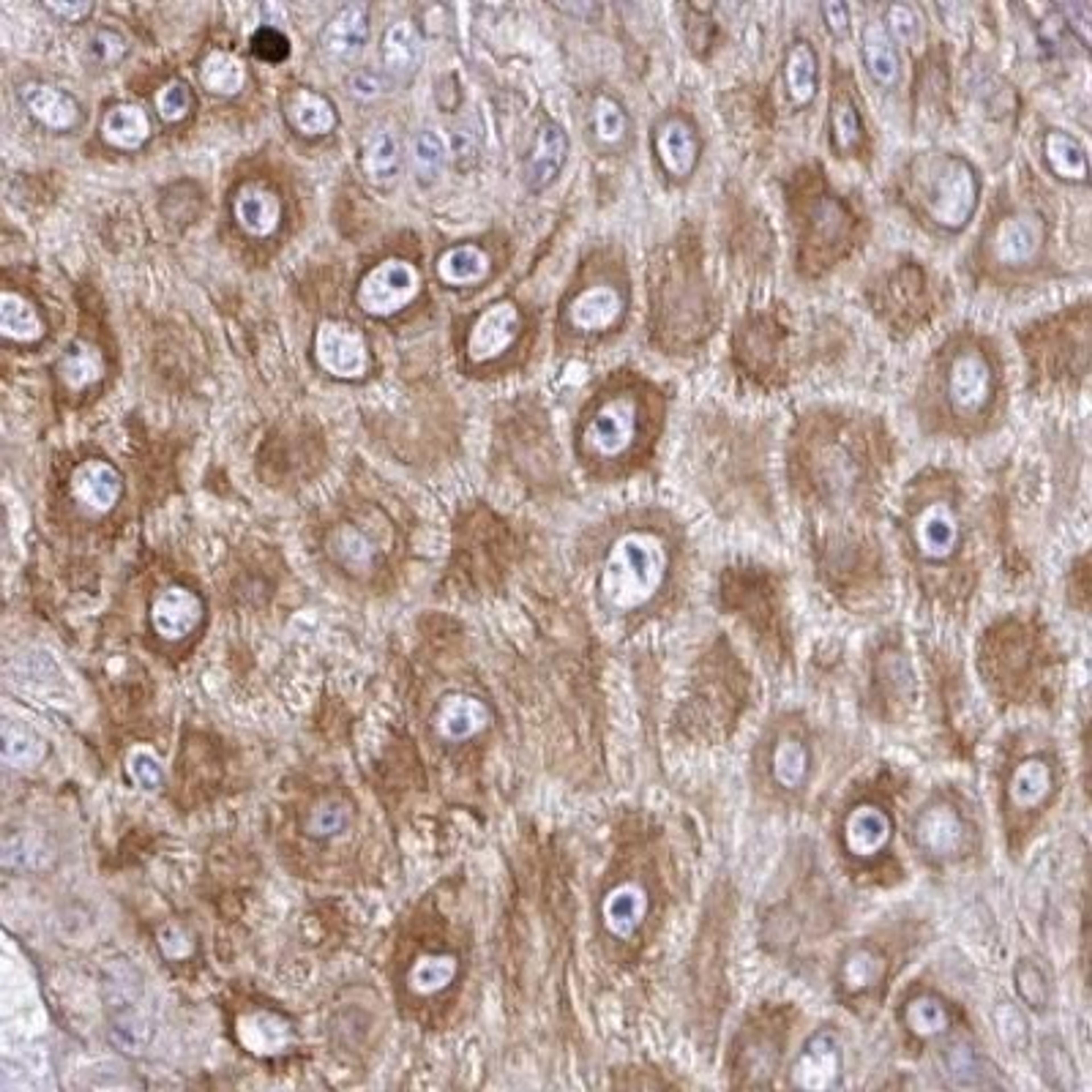 Immunohistochemistry: TAF1D Antibody [NBP2-31821] - skin cancer