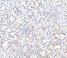 Detection of human BAP1 in FFPE prostate carcinoma by IHC.