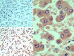 Immunohistochemistry-Paraffin: SMAD3 Antibody [NB100-56479] - analysis using SMAD3 antibody. Formalin-fixed, paraffin-embedded human liver tissue probed with SMAD3 antibody (bottom left, right) and isotype control antibody (top left) at 10 ug/ml.