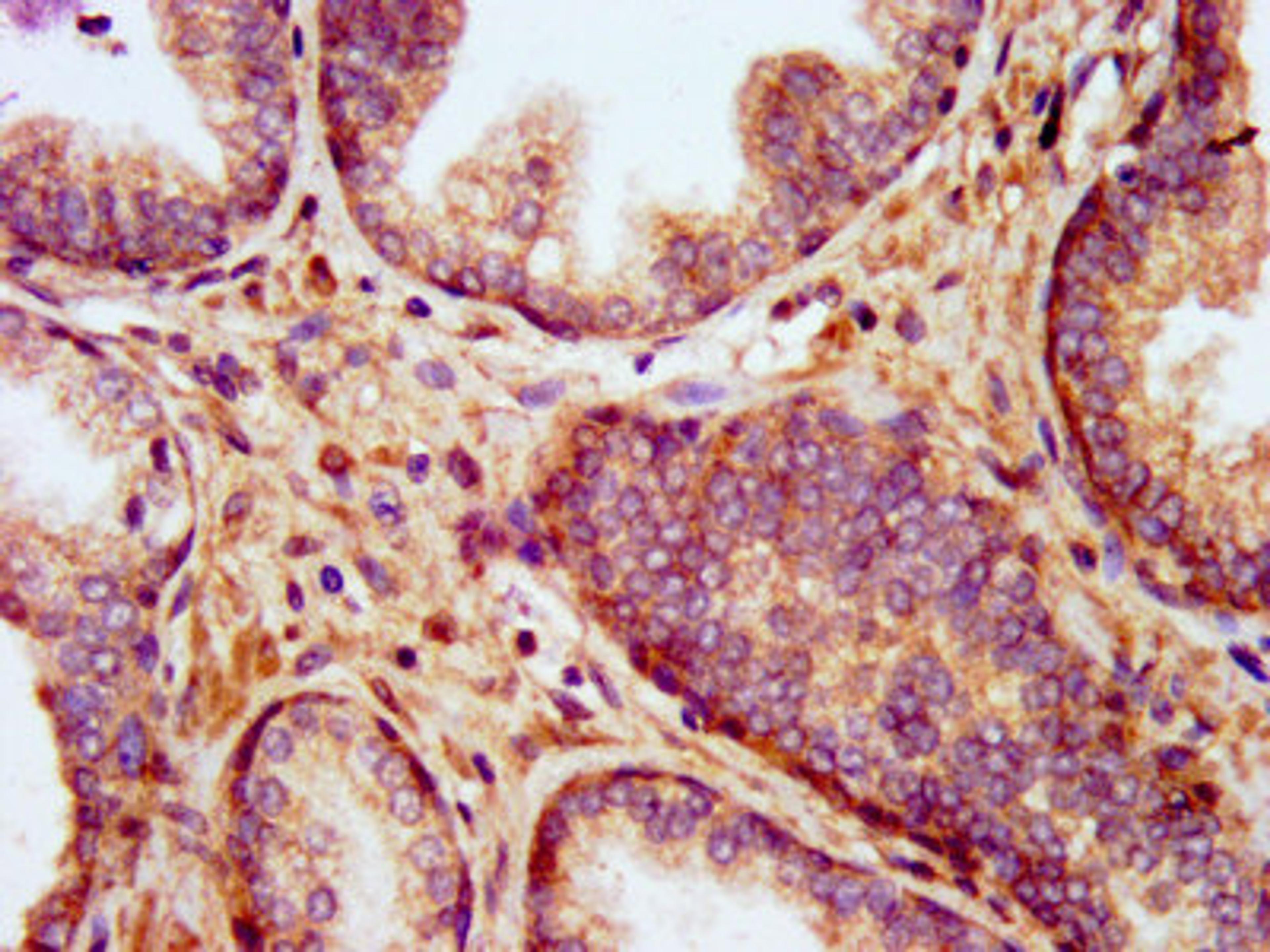 IHC image of CSB-PA686387LA01HU diluted at 1:400 and staining in paraffin-embedded human prostate cancer performed on a Leica BondTM system. After dewaxing and hydration, antigen retrieval was mediated by high pressure in a citrate buffer (pH 6.0). Section was blocked with 10% normal goat serum 30min at RT. Then primary antibody (1% BSA) was incubated at 4&deg;C overnight. The primary is detected by a biotinylated secondary antibody and visualized using an HRP conjugated SP system.