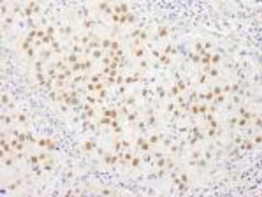 Immunohistochemistry-Paraffin: WHIP Antibody [NB110-61626] - FFPE section of human breast carcinoma.   Affinity purified rabbit anti-WRNIP1 used at a dilution of 1:250.