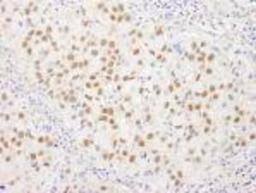 Immunohistochemistry-Paraffin: WHIP Antibody [NB110-61626] - FFPE section of human breast carcinoma.   Affinity purified rabbit anti-WRNIP1 used at a dilution of 1:250.