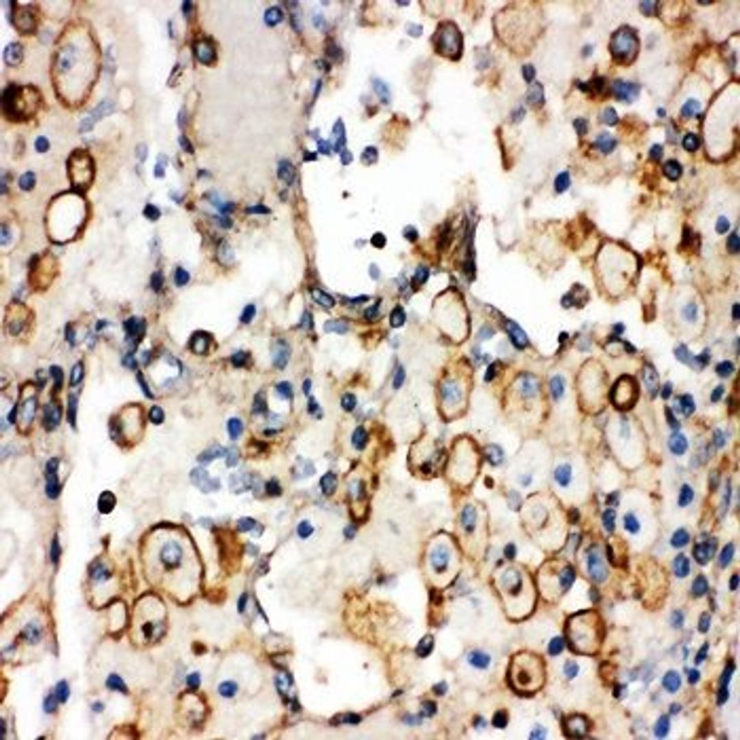 Immunohistochemical analysis of formalin-fixed paraffin embedded Human Lung Cancer Tissue using ITGA1 antibody