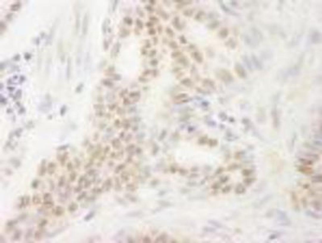 Immunohistochemistry-Paraffin: DEK Antibody [NB100-61057] - FFPE section of human stomach carcinoma.  Affinity purified rabbit anti-DEK used at a dilution of 1:250.