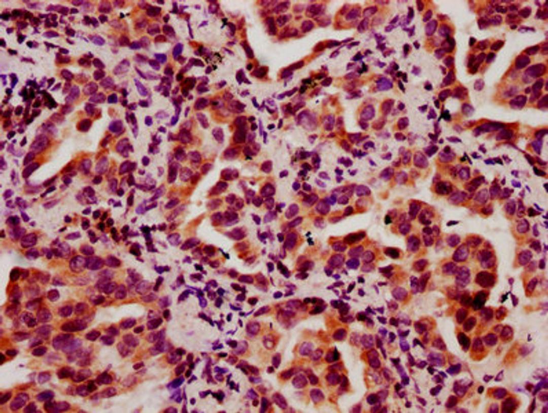 IHC image of CSB-PA010403OA05nbhbHU diluted at 1:10 and staining in paraffin-embedded human lung cancer performed on a Leica BondTM system. After dewaxing and hydration, antigen retrieval was mediated by high pressure in a citrate buffer (pH 6.0). Section was blocked with 10% normal goat serum 30min at RT. Then primary antibody (1% BSA) was incubated at 4°C overnight. The primary is detected by a biotinylated secondary antibody and visualized using an HRP conjugated SP system.