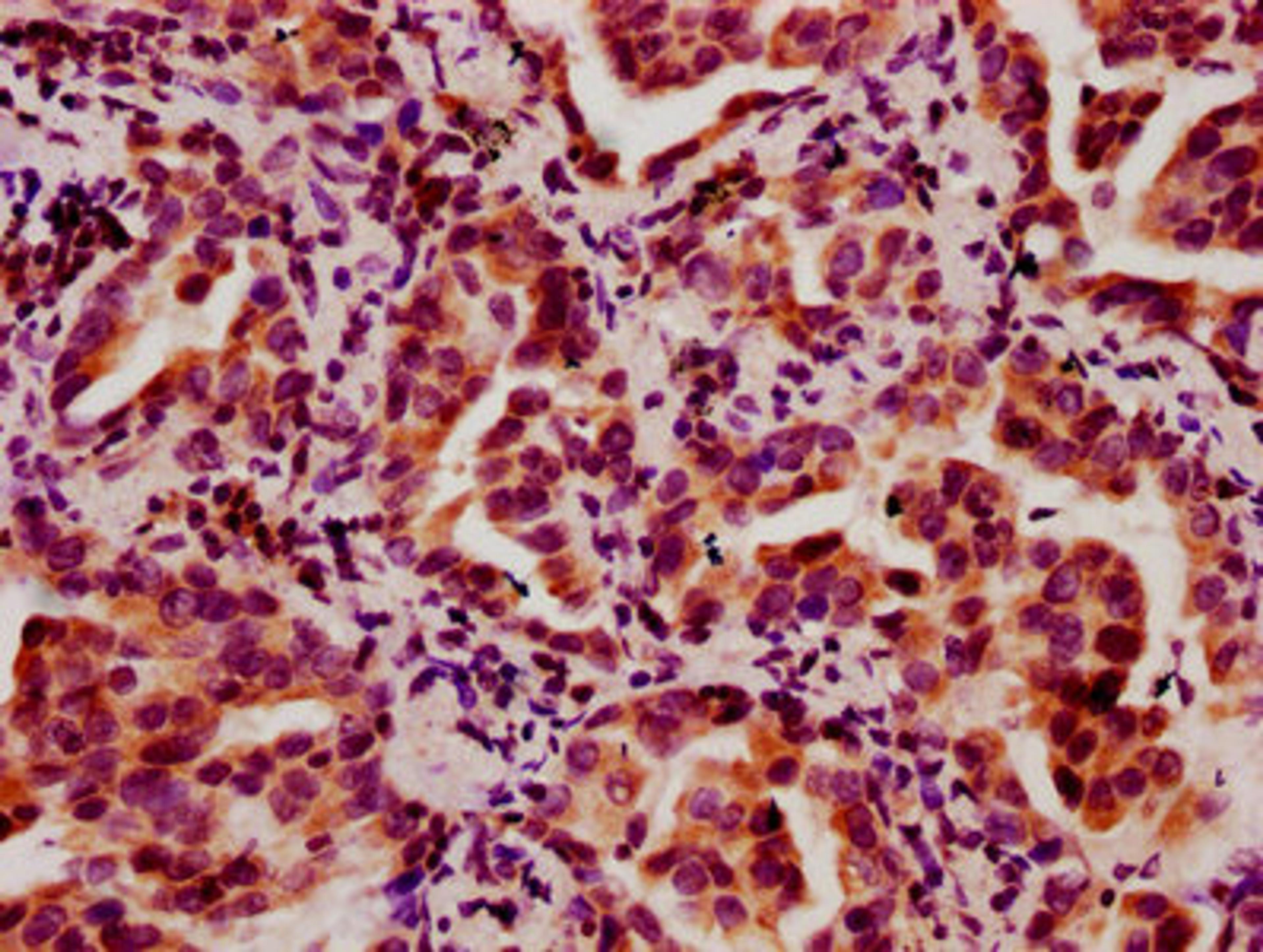 IHC image of CSB-PA010403OA05nbhbHU diluted at 1:10 and staining in paraffin-embedded human lung cancer performed on a Leica BondTM system. After dewaxing and hydration, antigen retrieval was mediated by high pressure in a citrate buffer (pH 6.0). Section was blocked with 10% normal goat serum 30min at RT. Then primary antibody (1% BSA) was incubated at 4°C overnight. The primary is detected by a biotinylated secondary antibody and visualized using an HRP conjugated SP system.