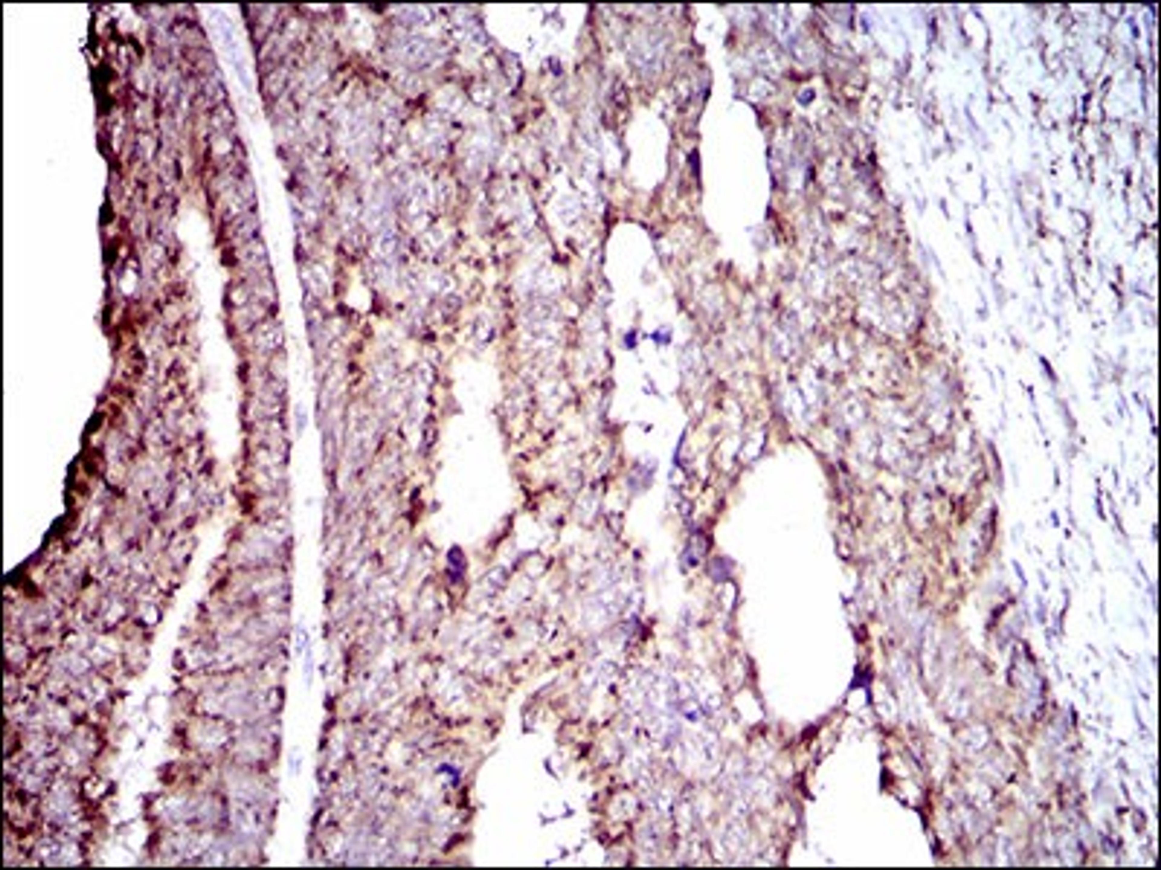 Immunohistochemistry: ALDH2 Antibody (4G6A3) [NBP2-37397] - Immunohistochemical analysis of paraffin-embedded rectum cancer tissues using ALDH2 mouse mAb with DAB staining.