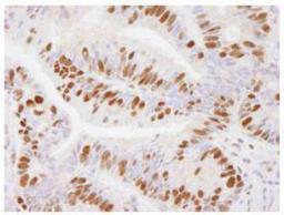 Immunohistochemistry-Paraffin: USP7 Antibody [NB100-513] - Human stomach adenocarcinoma.  Antibody used at a dilution of 1:500. Detection: DAB