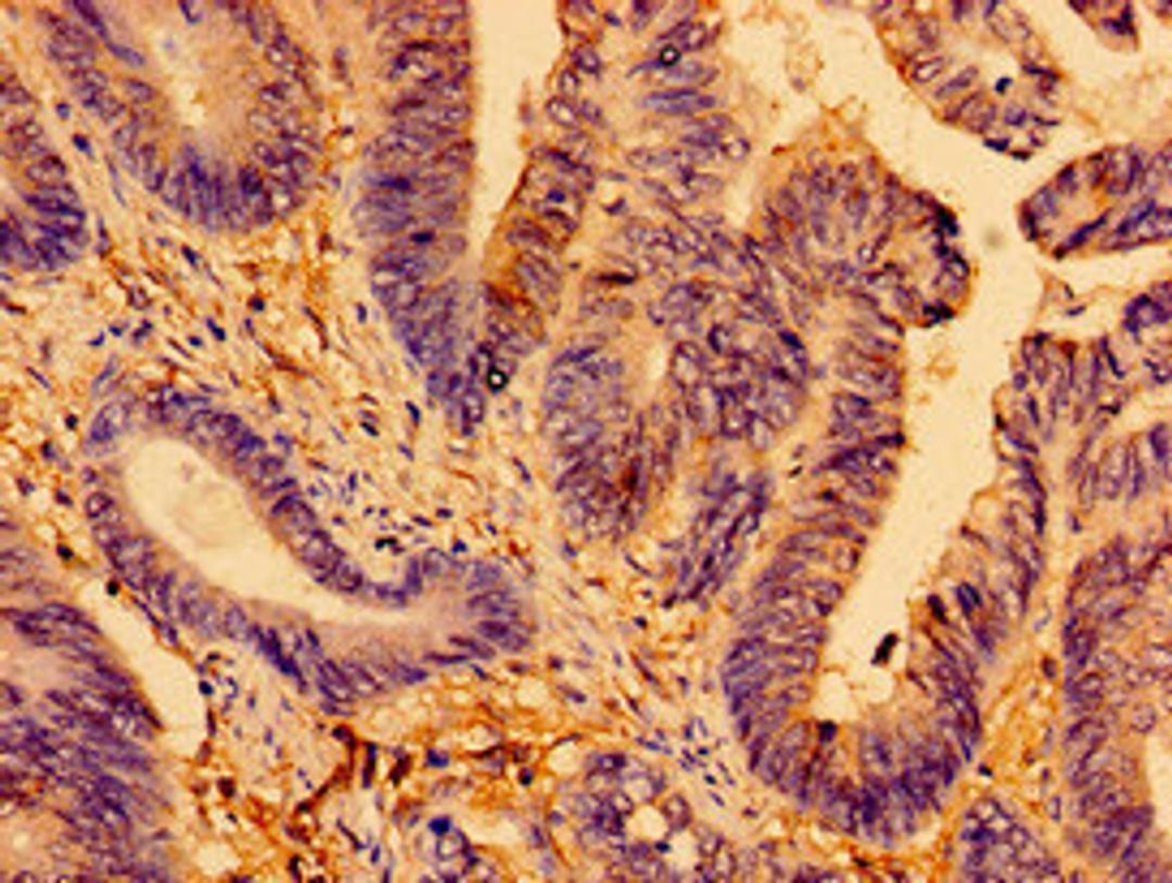 Immunohistochemistry of paraffin-embedded human colon cancer using CSB-PA001681LA01HU at dilution of 1:100