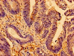 Immunohistochemistry of paraffin-embedded human colon cancer using CSB-PA001681LA01HU at dilution of 1:100
