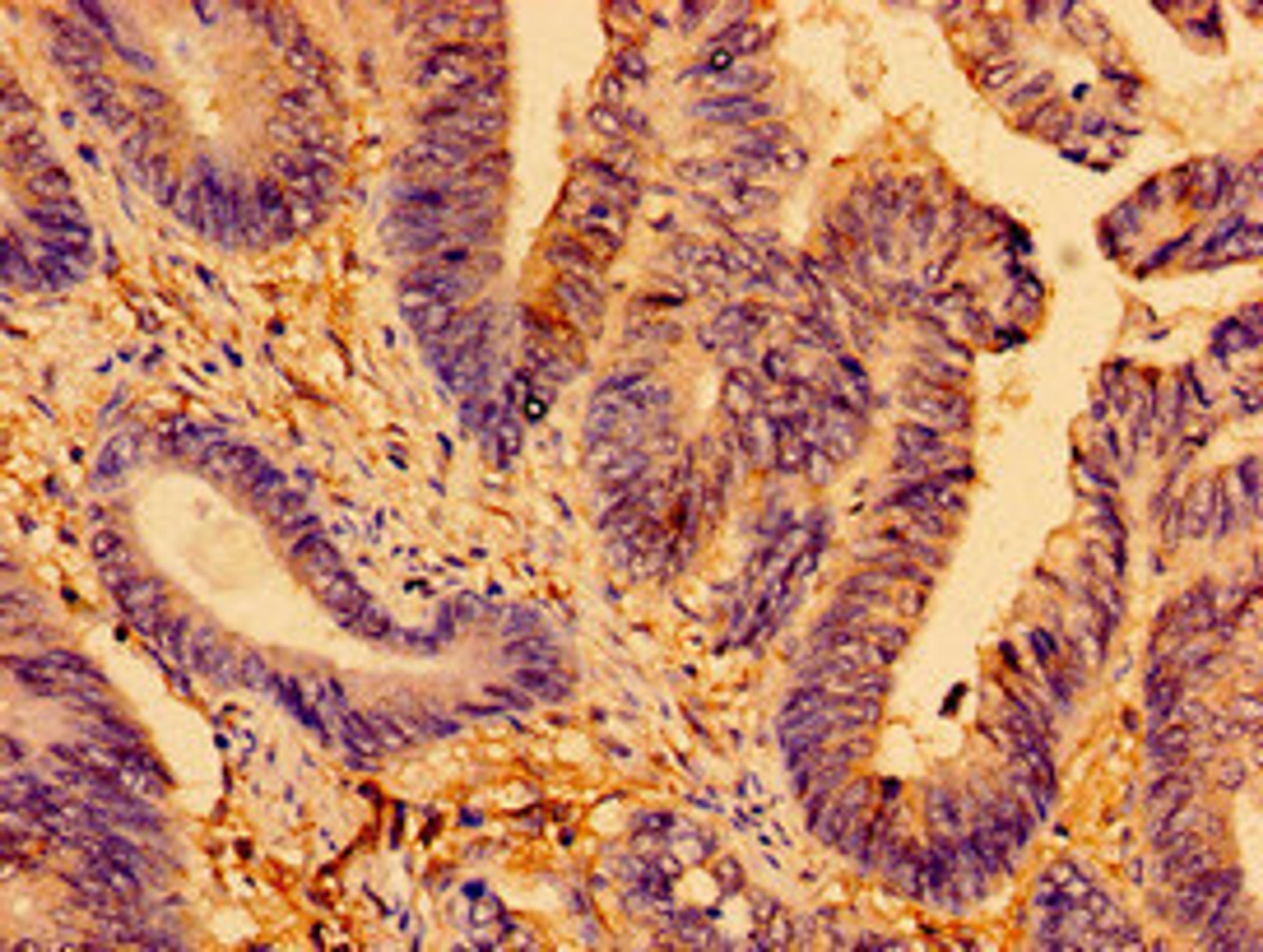 Immunohistochemistry of paraffin-embedded human colon cancer using CSB-PA001681LA01HU at dilution of 1:100