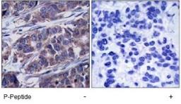 Immunohistochemistry-Paraffin: DOK1 [p Tyr362] Antibody [NB100-82112] - Immunohistochemical analysis of paraffin-embedded human breast carcinoma tissue, using p62Dok (phospho-Tyr362) antibody.