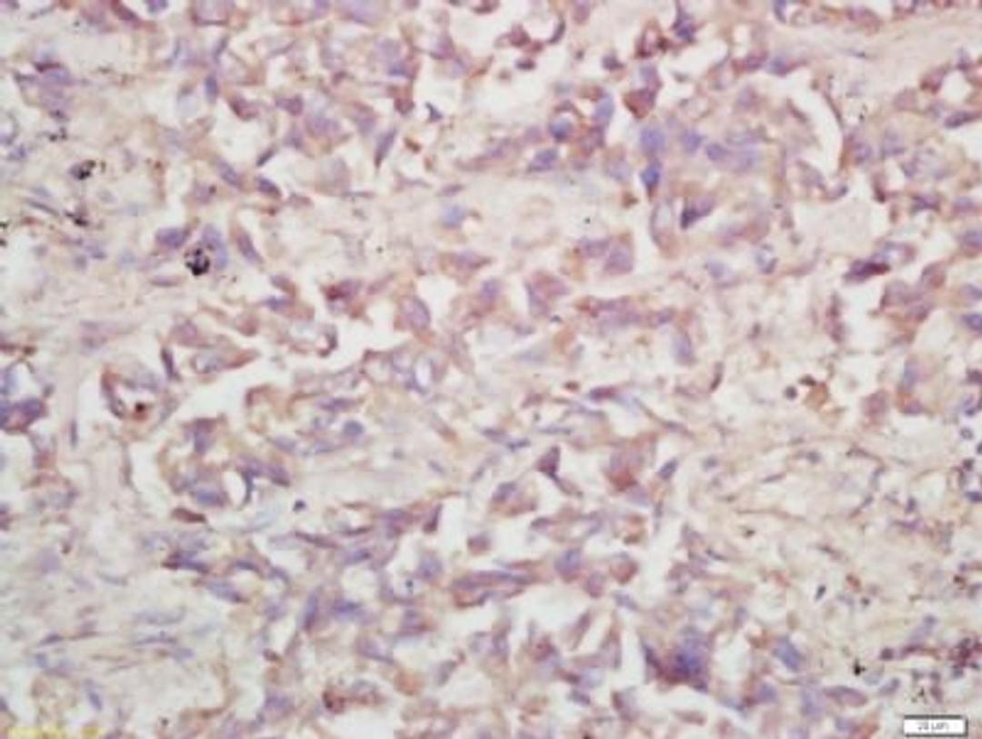 Immunohistochemical staining of human lung carcinoma tissue using V-ATPase A1 antibody.