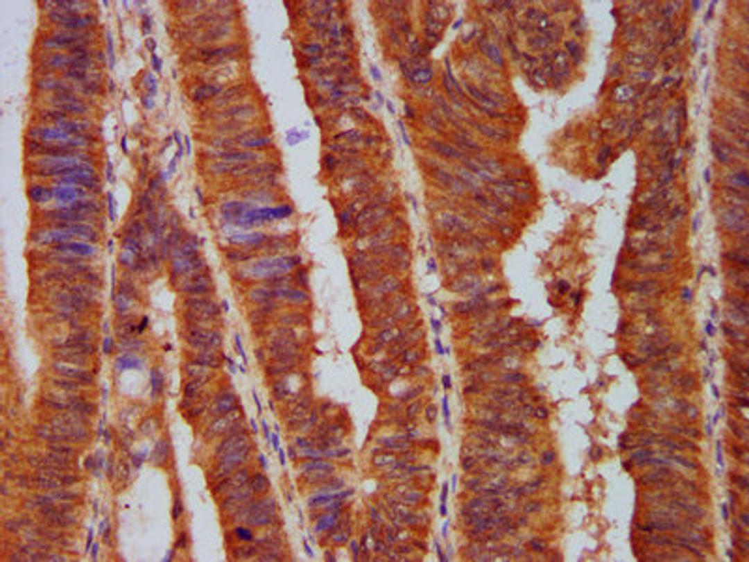 IHC image of CSB-PA619075LA01HU diluted at 1:500 and staining in paraffin-embedded human colon cancer performed on a Leica BondTM system. After dewaxing and hydration, antigen retrieval was mediated by high pressure in a citrate buffer (pH 6.0). Section was blocked with 10% normal goat serum 30min at RT. Then primary antibody (1% BSA) was incubated at 4&deg;C overnight. The primary is detected by a biotinylated secondary antibody and visualized using an HRP conjugated SP system.