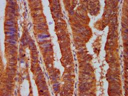 IHC image of CSB-PA619075LA01HU diluted at 1:500 and staining in paraffin-embedded human colon cancer performed on a Leica BondTM system. After dewaxing and hydration, antigen retrieval was mediated by high pressure in a citrate buffer (pH 6.0). Section was blocked with 10% normal goat serum 30min at RT. Then primary antibody (1% BSA) was incubated at 4&deg;C overnight. The primary is detected by a biotinylated secondary antibody and visualized using an HRP conjugated SP system.