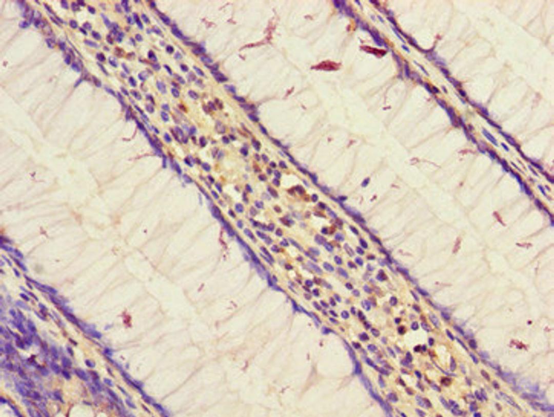 Immunohistochemistry of paraffin-embedded human colon cancer using CSB-PA885805LA01HU at dilution of 1: 100