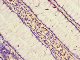 Immunohistochemistry of paraffin-embedded human colon cancer using CSB-PA885805LA01HU at dilution of 1: 100