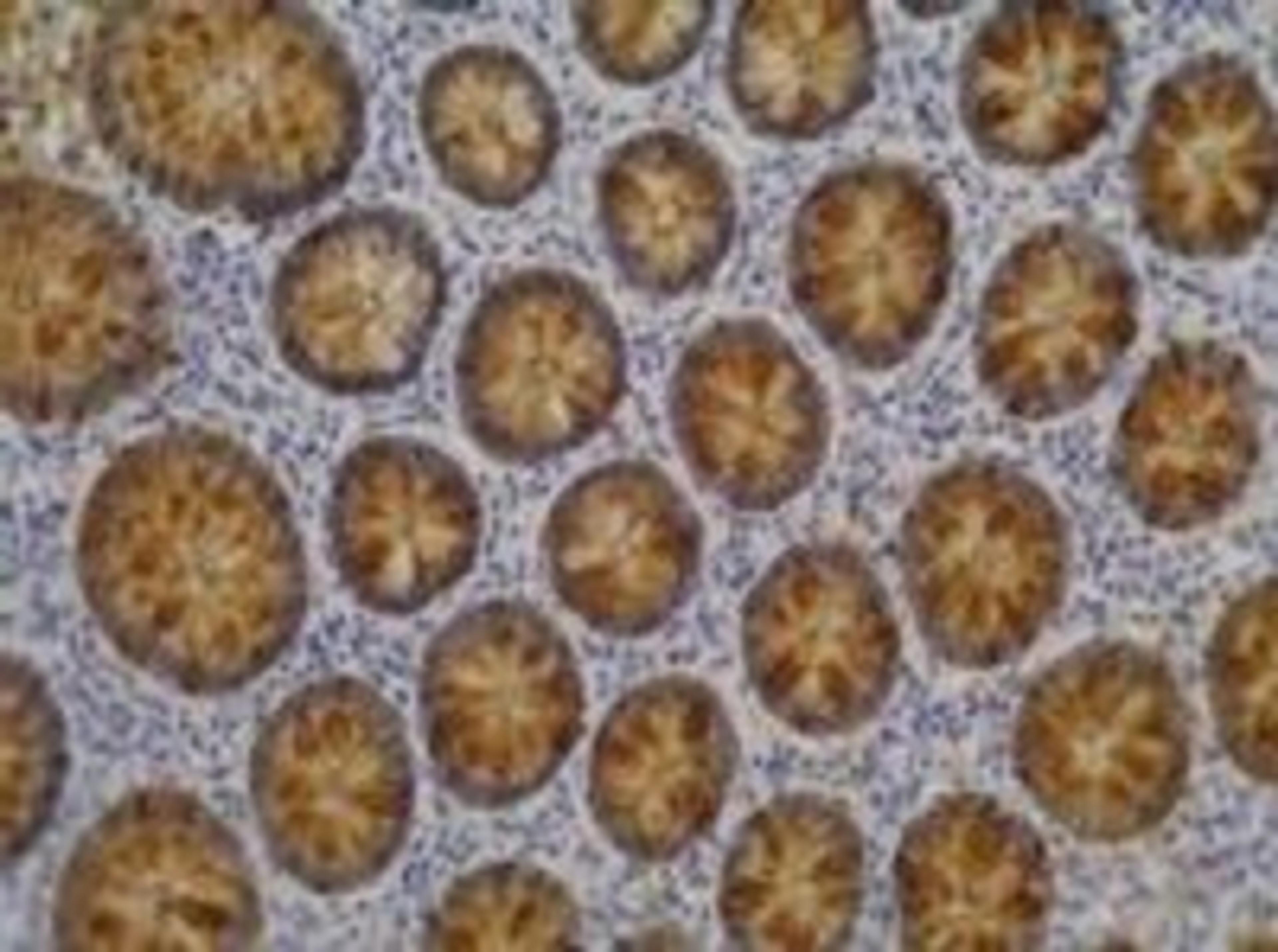 Immunohistochemistry: FUT3/Blood Group Lewis A Antibody (7LE) [NB500-525] - Fig. 1. Immunohistochemistry staining of colorectal adenocarcinoma (paraffin-embedded sections) with anti-FUT3/Blood Group Lewis A (7LE).