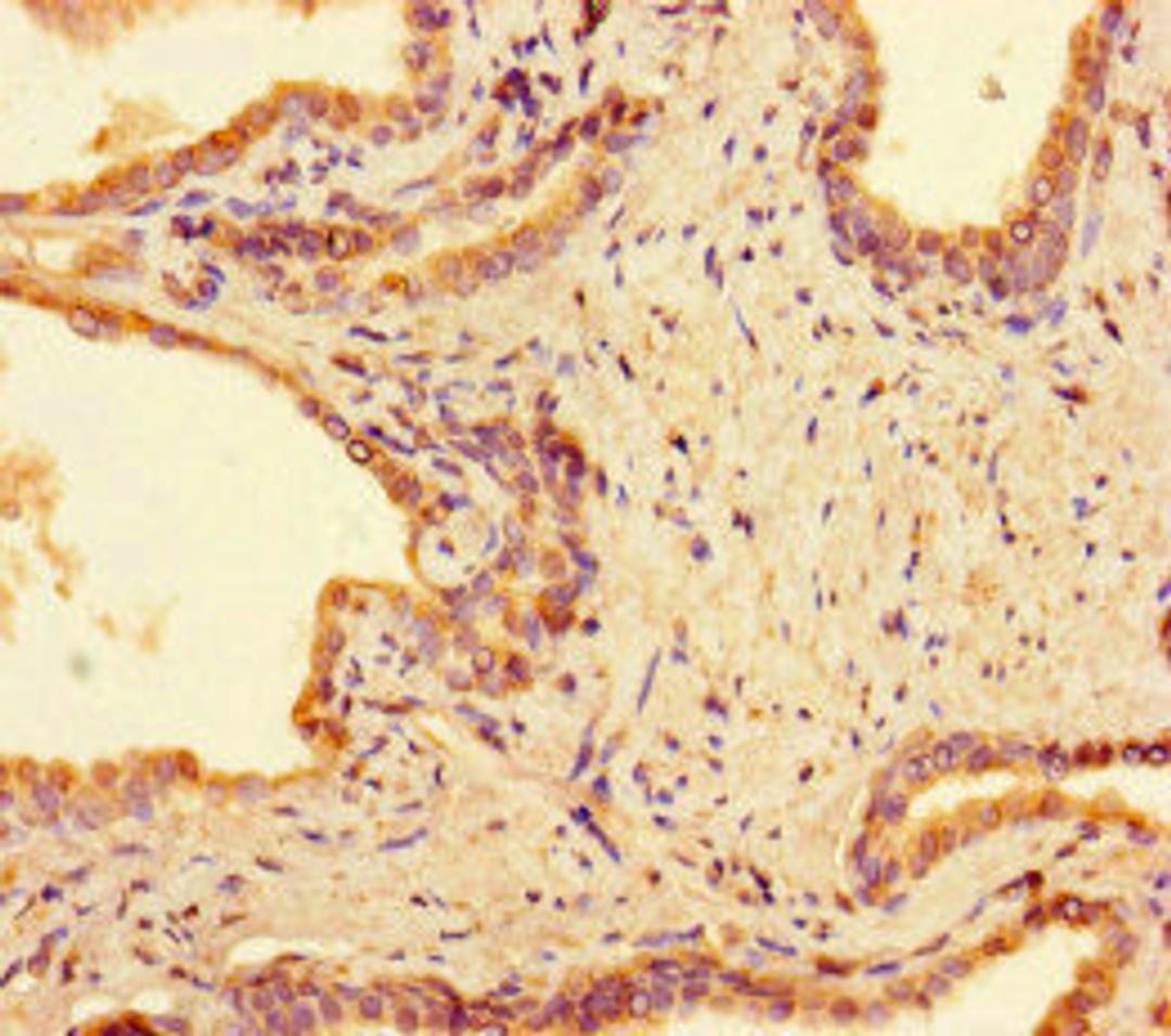 Immunohistochemistry of paraffin-embedded human prostate cancer using CSB-PA892345LA01HU at dilution of 1:100