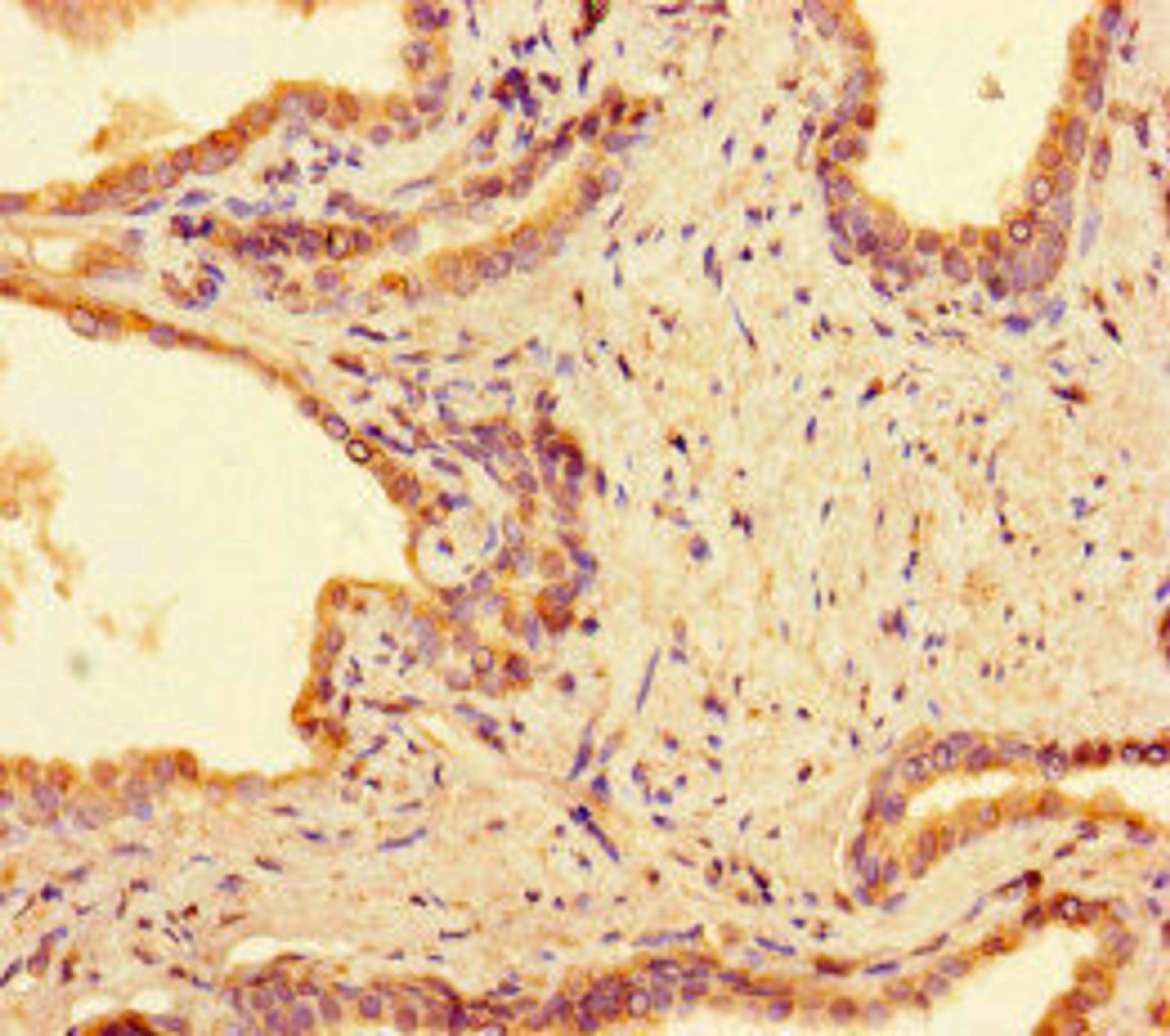 Immunohistochemistry of paraffin-embedded human prostate cancer using CSB-PA892345LA01HU at dilution of 1:100