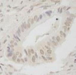 Immunohistochemistry-Paraffin: ANKRD28 Antibody [NB100-41419] - FFPE section of human stomach carcinoma.  Antibody used at a dilution of 1:250.