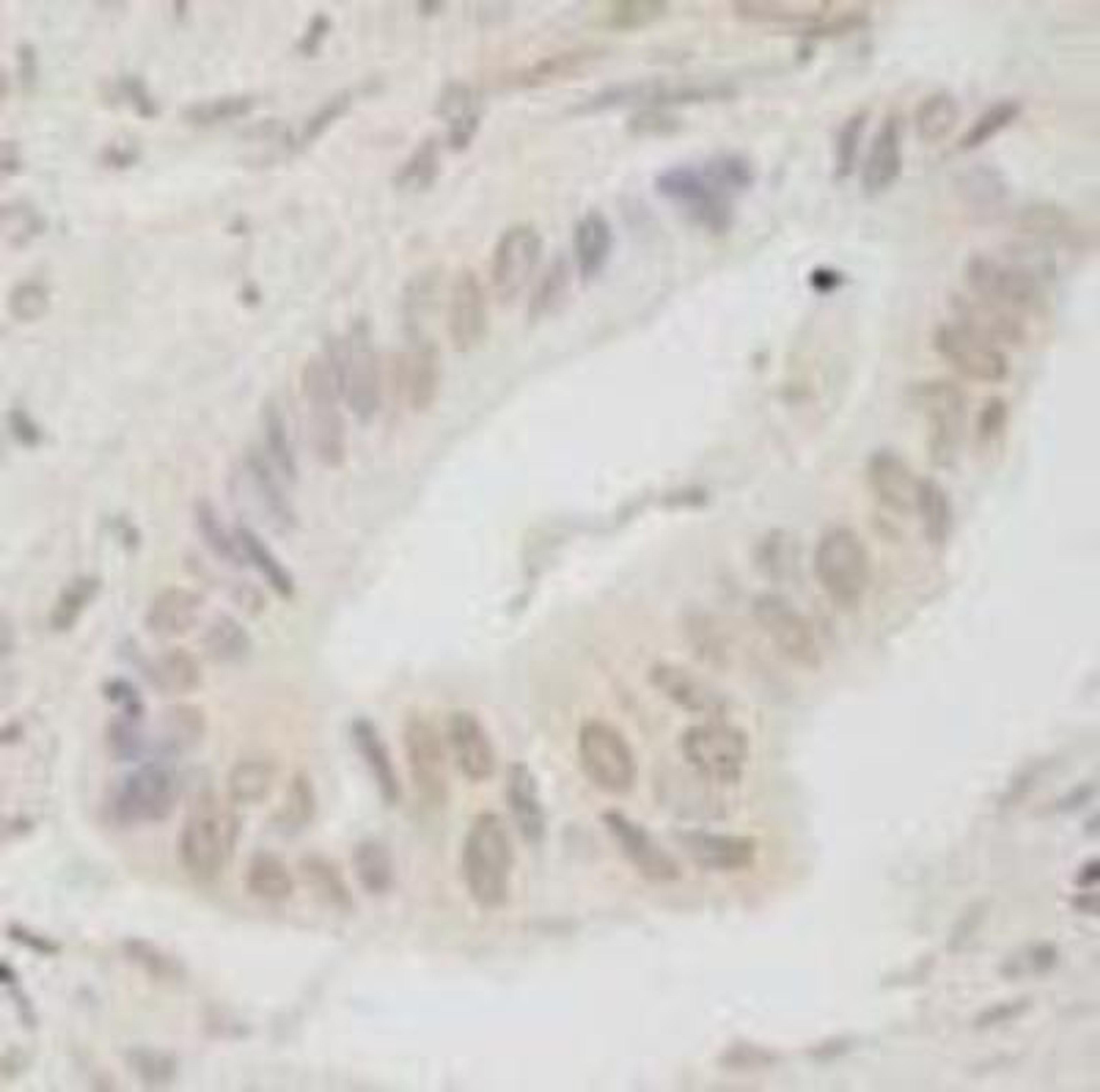 Immunohistochemistry-Paraffin: ANKRD28 Antibody [NB100-41419] - FFPE section of human stomach carcinoma.  Antibody used at a dilution of 1:250.