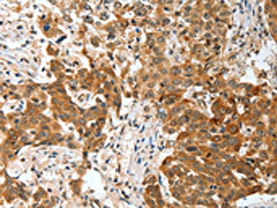 The image on the left is immunohistochemistry of paraffin-embedded Human esophagus cancer tissue using CSB-PA200381(BNIP1 Antibody) at dilution 1/30, on the right is treated with fusion protein. (Original magnification: ×200)