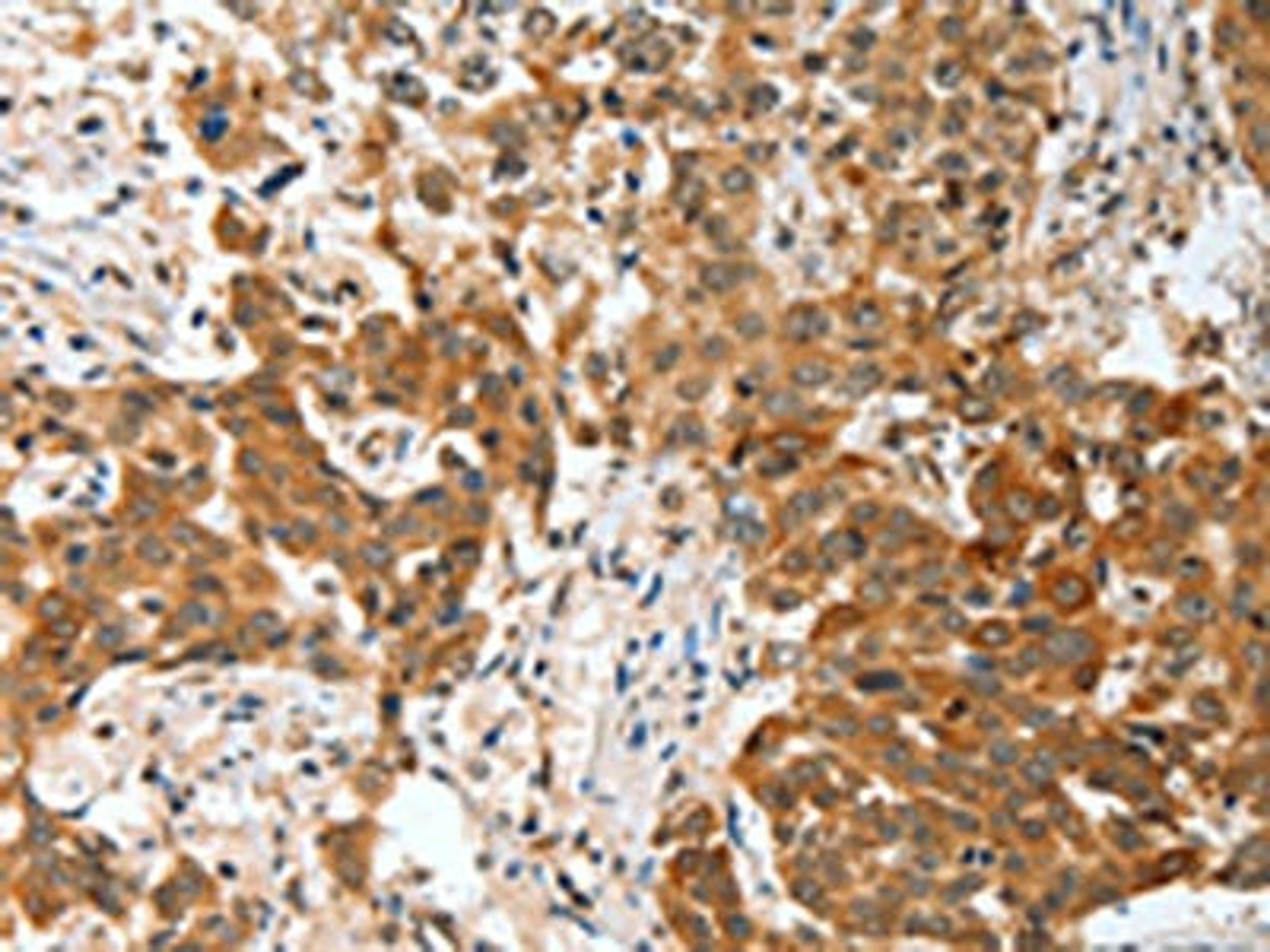 The image on the left is immunohistochemistry of paraffin-embedded Human esophagus cancer tissue using CSB-PA200381(BNIP1 Antibody) at dilution 1/30, on the right is treated with fusion protein. (Original magnification: ×200)