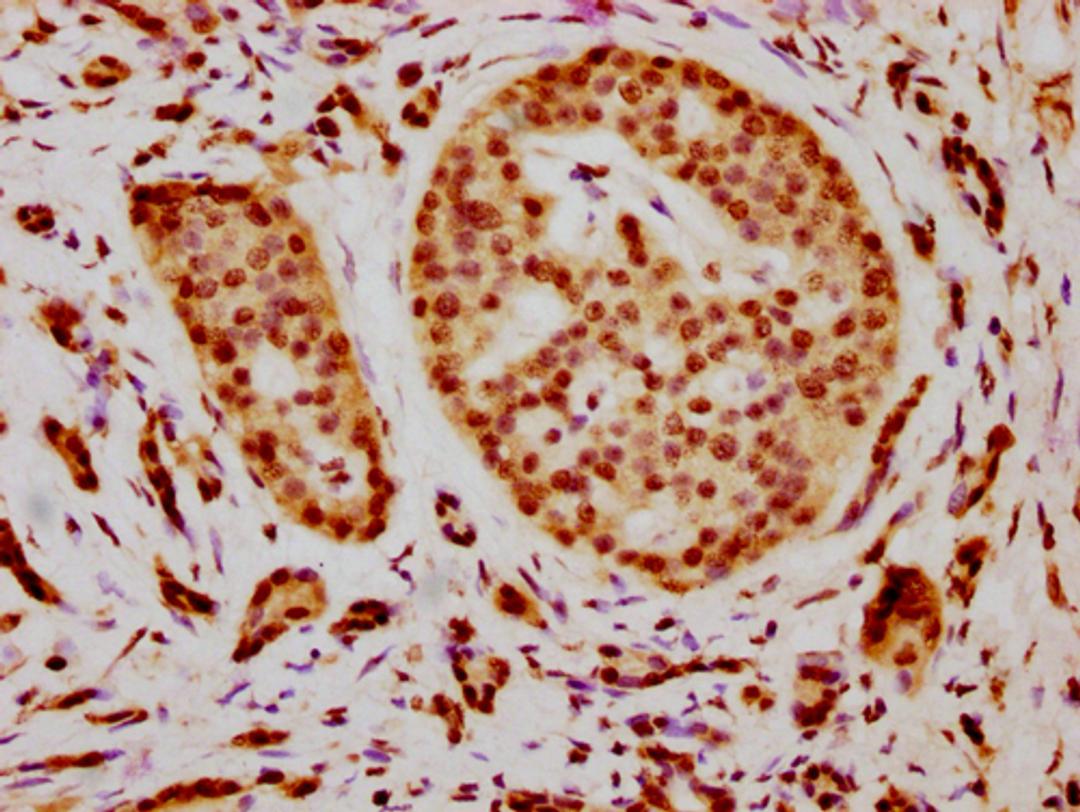 IHC image of CSB-PA010376OA21nacHU diluted at 1:15 and staining in paraffin-embedded human pancreatic cancer performed on a Leica BondTM system. After dewaxing and hydration, antigen retrieval was mediated by high pressure in a citrate buffer (pH 6.0). Section was blocked with 10% normal goat serum 30min at RT. Then primary antibody (1% BSA) was incubated at 4°C overnight. The primary is detected by a biotinylated secondary antibody and visualized using an HRP conjugated SP system.