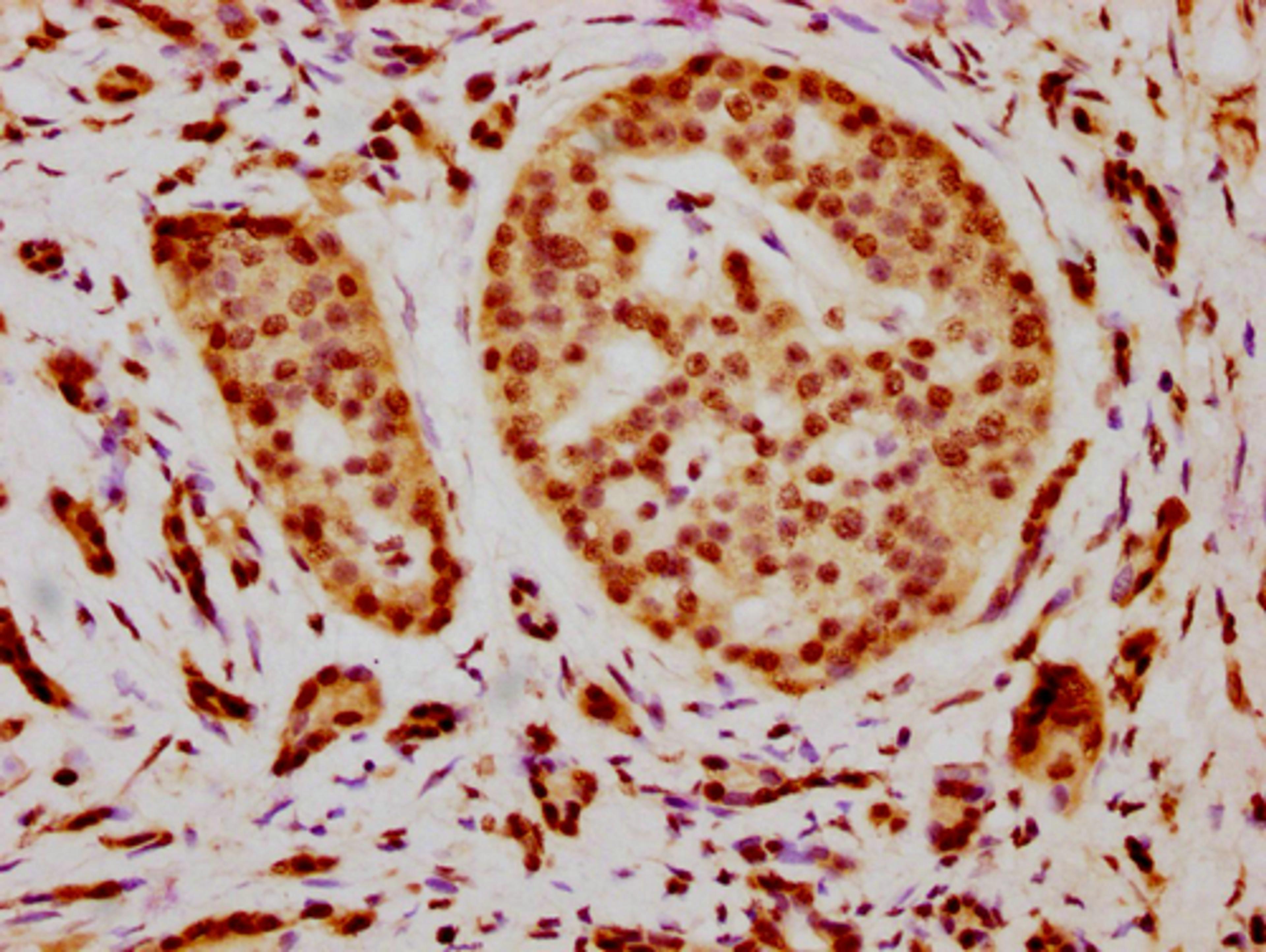 IHC image of CSB-PA010376OA21nacHU diluted at 1:15 and staining in paraffin-embedded human pancreatic cancer performed on a Leica BondTM system. After dewaxing and hydration, antigen retrieval was mediated by high pressure in a citrate buffer (pH 6.0). Section was blocked with 10% normal goat serum 30min at RT. Then primary antibody (1% BSA) was incubated at 4°C overnight. The primary is detected by a biotinylated secondary antibody and visualized using an HRP conjugated SP system.