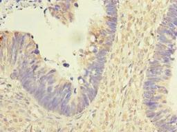 Immunohistochemistry of paraffin-embedded human ovarian cancer using CSB-PA887109LA01HU at dilution of 1:100
