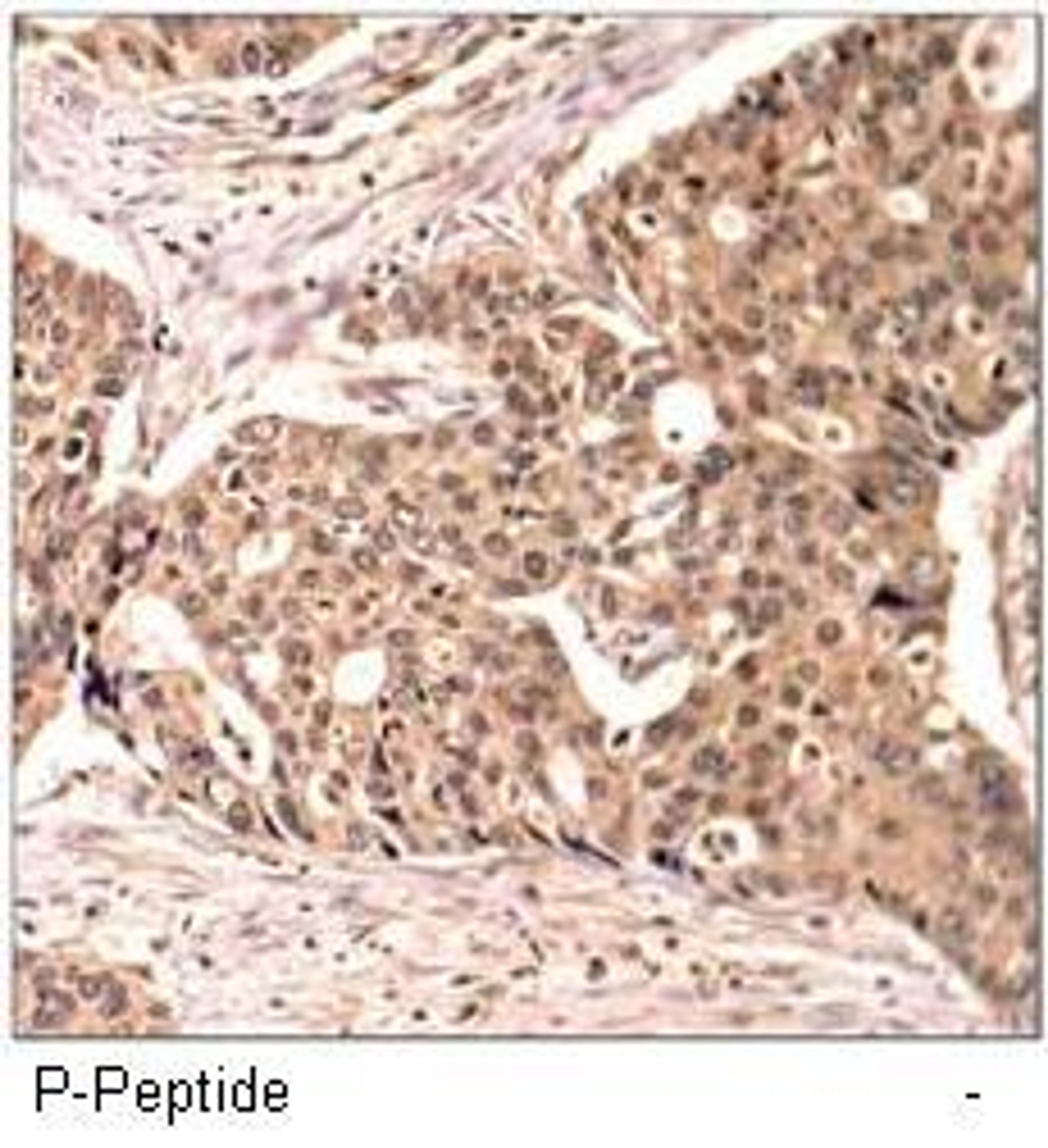 Immunohistochemical analysis of paraffin-embedded human breast carcinoma tissue using Paxillin (phospho-Tyr118) antibody