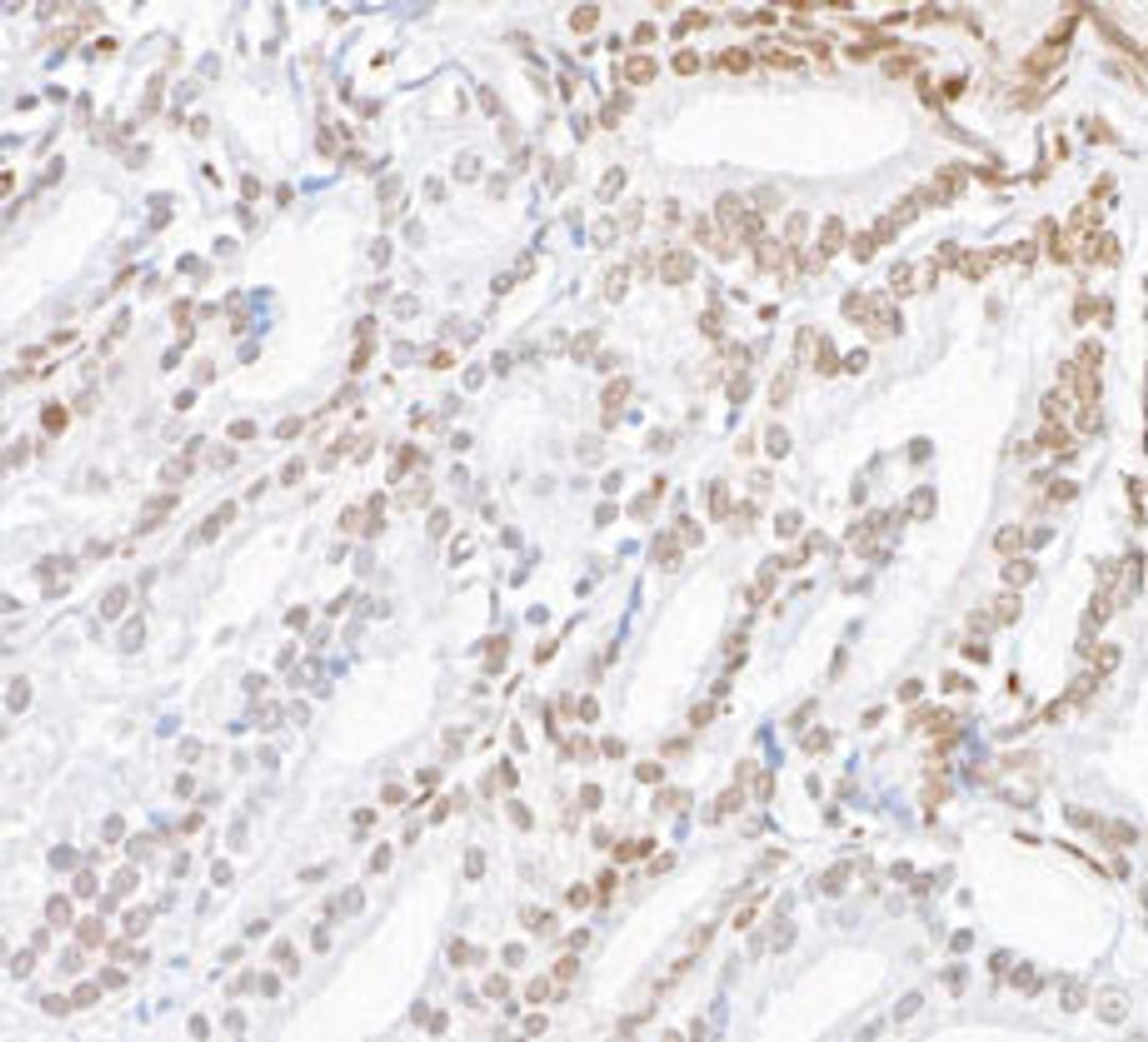 Detection of human ZEB2/SIP in FFPE prostate carcinoma by immunohistochemistry.