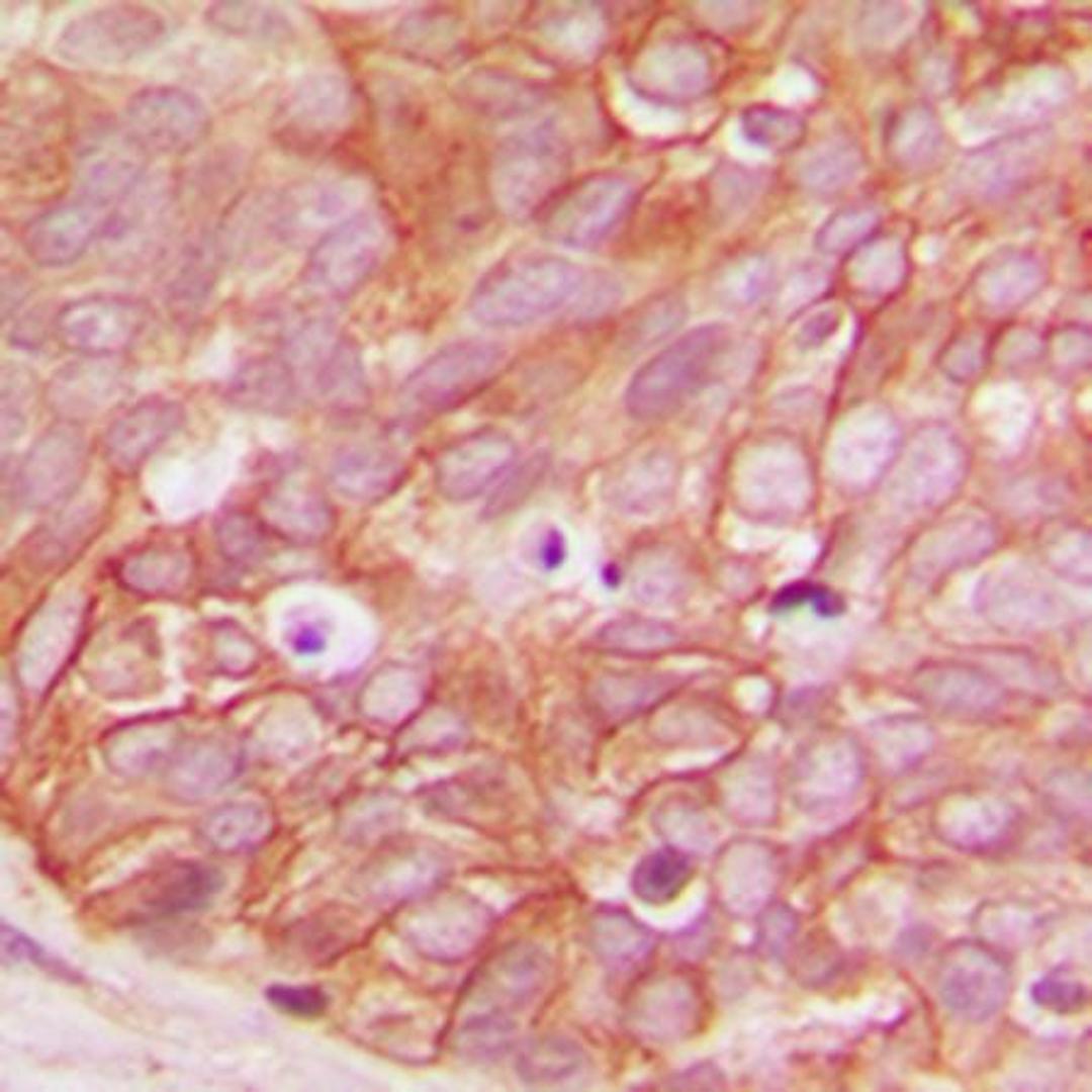 Immunohistochemical analysis of formalin-fixed and paraffin-embedded human breast cancer tissue using beta-catenin (phospho-S33) antibody