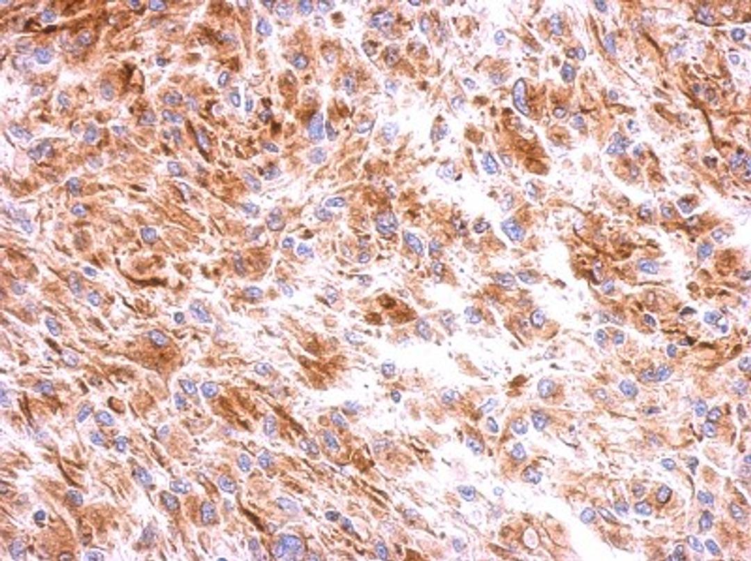 Immunohistochemistry-Paraffin: beta II Tubulin A Antibody [NBP2-15581] - Immunohistochemical analysis of paraffin-embedded U373 xenograft, using antibody at 1:500 dilution.