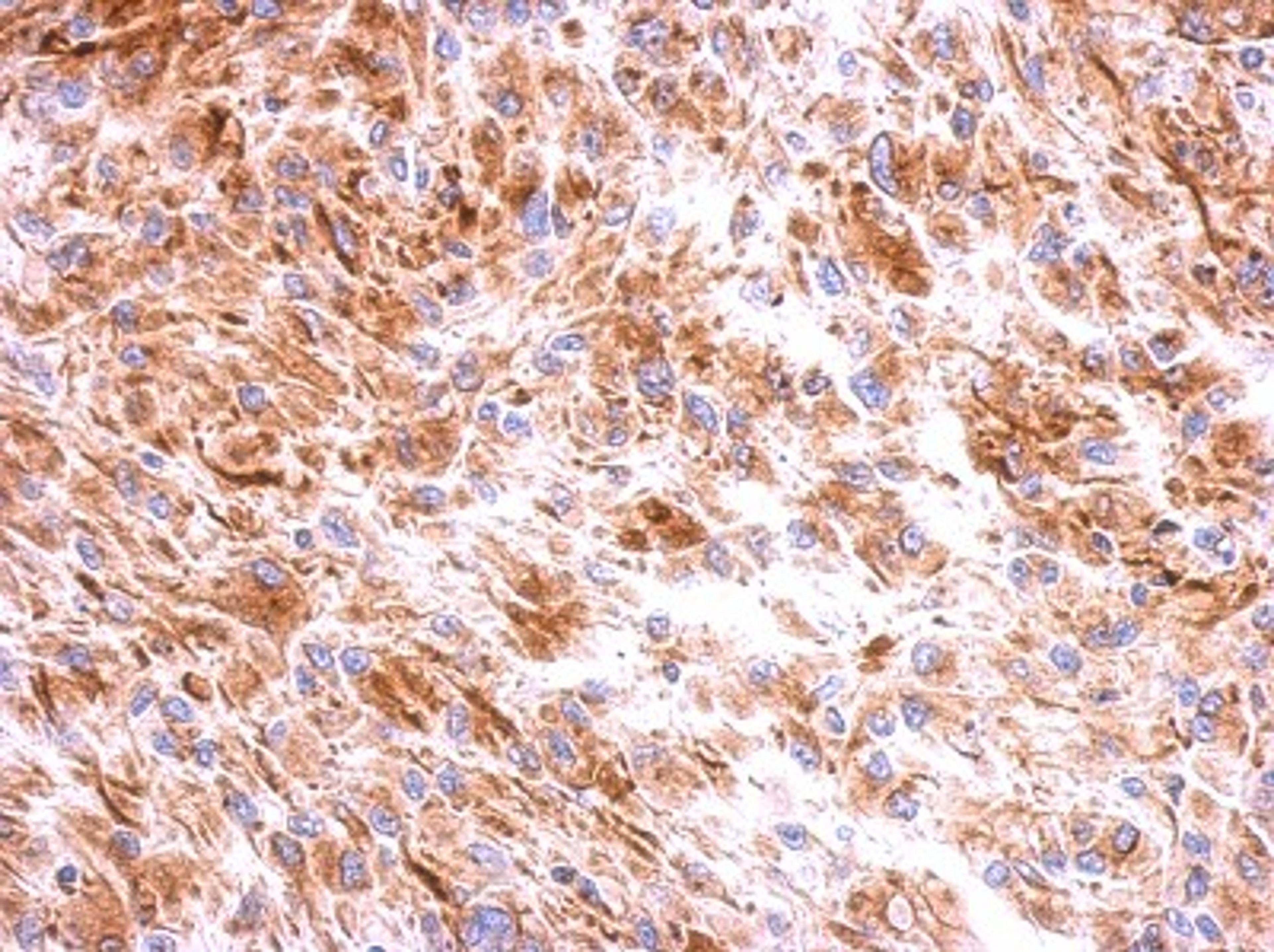 Immunohistochemistry-Paraffin: beta II Tubulin A Antibody [NBP2-15581] - Immunohistochemical analysis of paraffin-embedded U373 xenograft, using antibody at 1:500 dilution.