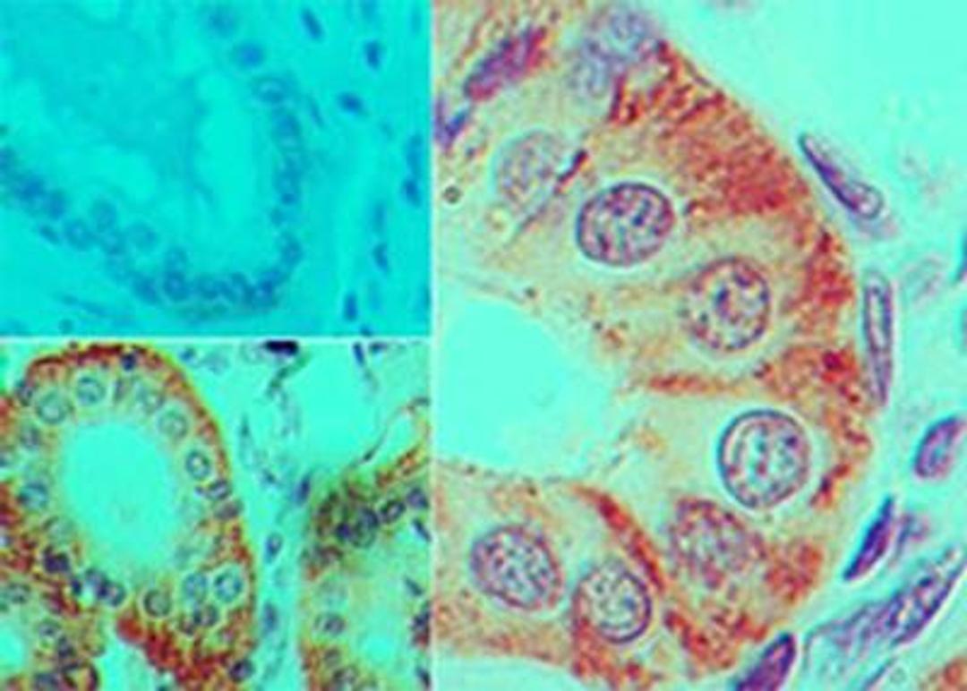 Immunohistochemistry-Paraffin: IL-17F Antibody (4H1629) [NBP2-27327] - IHC-P analysis of IL-17F in formalin-fixed paraffin-embedded human colon tissue using an isotype control (top left) and IL-17F antibody  (bottom left and right) at 5 ug/ml concentration.