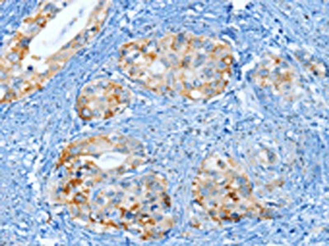 The image on the left is immunohistochemistry of paraffin-embedded Human cervical cancer tissue using CSB-PA141618(MUC15 Antibody) at dilution 1/25, on the right is treated with fusion protein. (Original magnification: ×200)