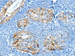 The image on the left is immunohistochemistry of paraffin-embedded Human cervical cancer tissue using CSB-PA141618(MUC15 Antibody) at dilution 1/25, on the right is treated with fusion protein. (Original magnification: ×200)
