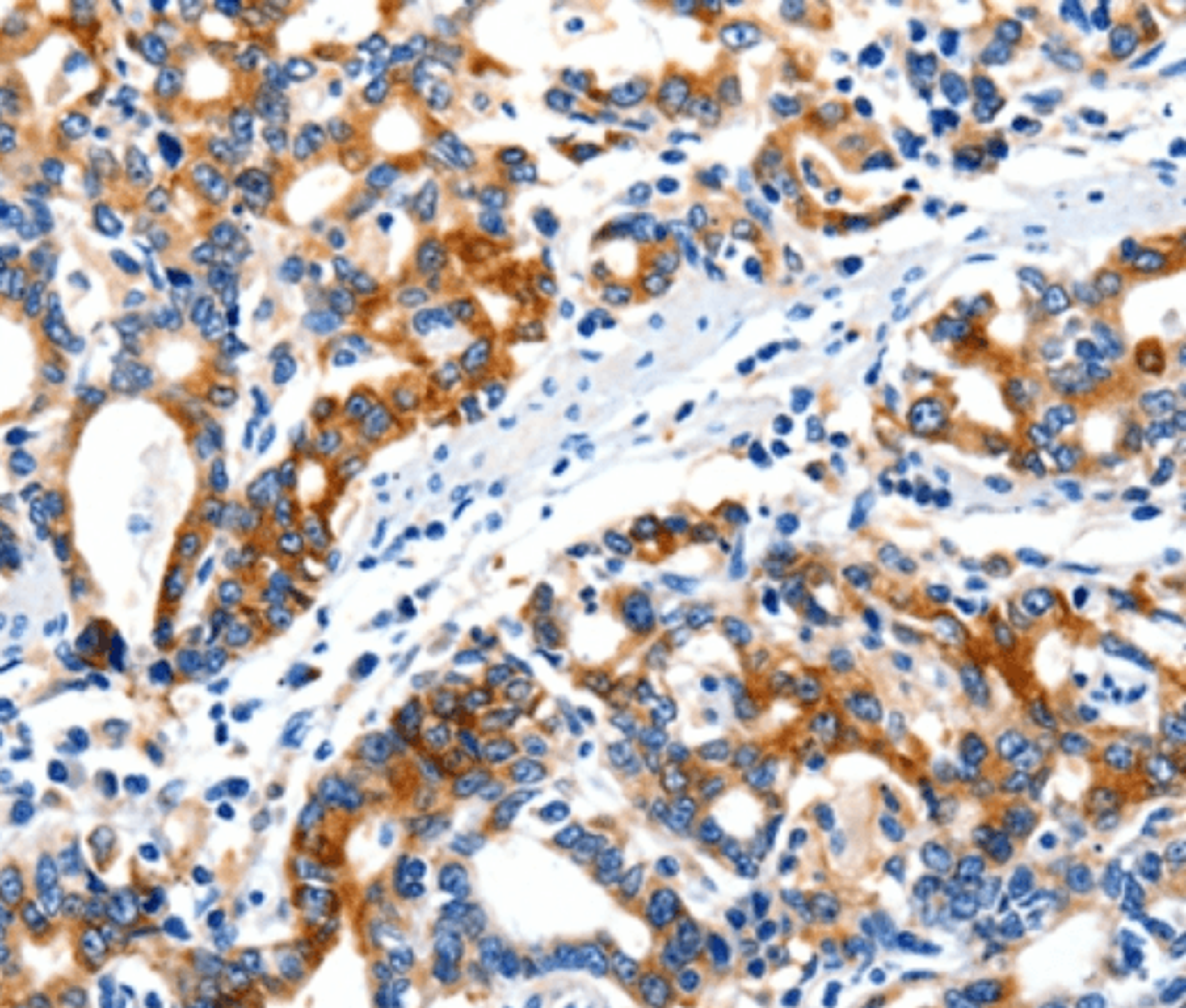 Immunohistochemical analysis of paraffin-embedded Human gastric cancer tissue using CD11c antibody