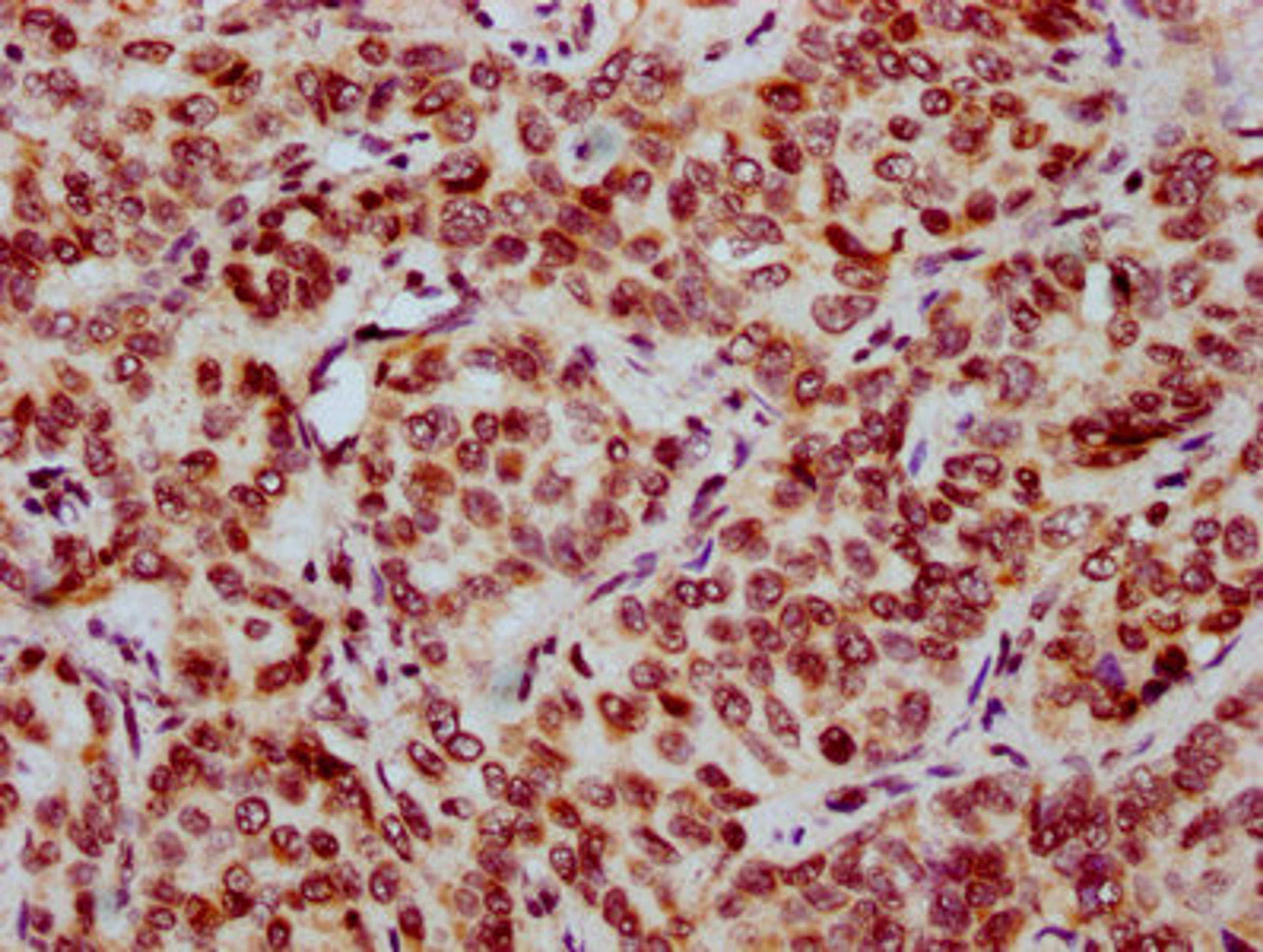 IHC image of CSB-PA010403OA12nbutHU diluted at 1:20 and staining in paraffin-embedded human liver cancer performed on a Leica BondTM system. After dewaxing and hydration, antigen retrieval was mediated by high pressure in a citrate buffer (pH 6.0). Section was blocked with 10% normal goat serum 30min at RT. Then primary antibody (1% BSA) was incubated at 4&deg;C overnight. The primary is detected by a biotinylated secondary antibody and visualized using an HRP conjugated SP system.