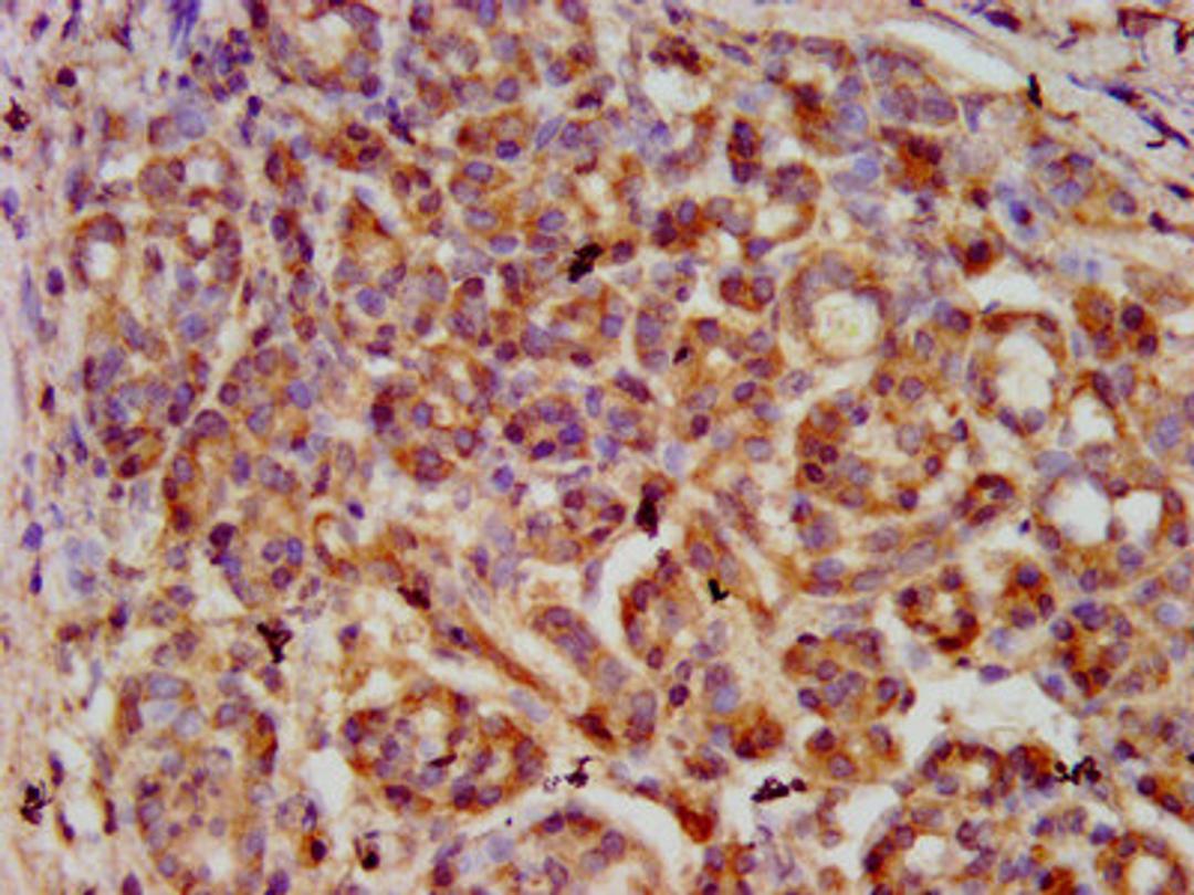 IHC image of CSB-PA021072LA01HU diluted at 1:600 and staining in paraffin-embedded human pancreatic cancer performed on a Leica BondTM system. After dewaxing and hydration, antigen retrieval was mediated by high pressure in a citrate buffer (pH 6.0). Section was blocked with 10% normal goat serum 30min at RT. Then primary antibody (1% BSA) was incubated at 4&deg;C overnight. The primary is detected by a biotinylated secondary antibody and visualized using an HRP conjugated SP system.