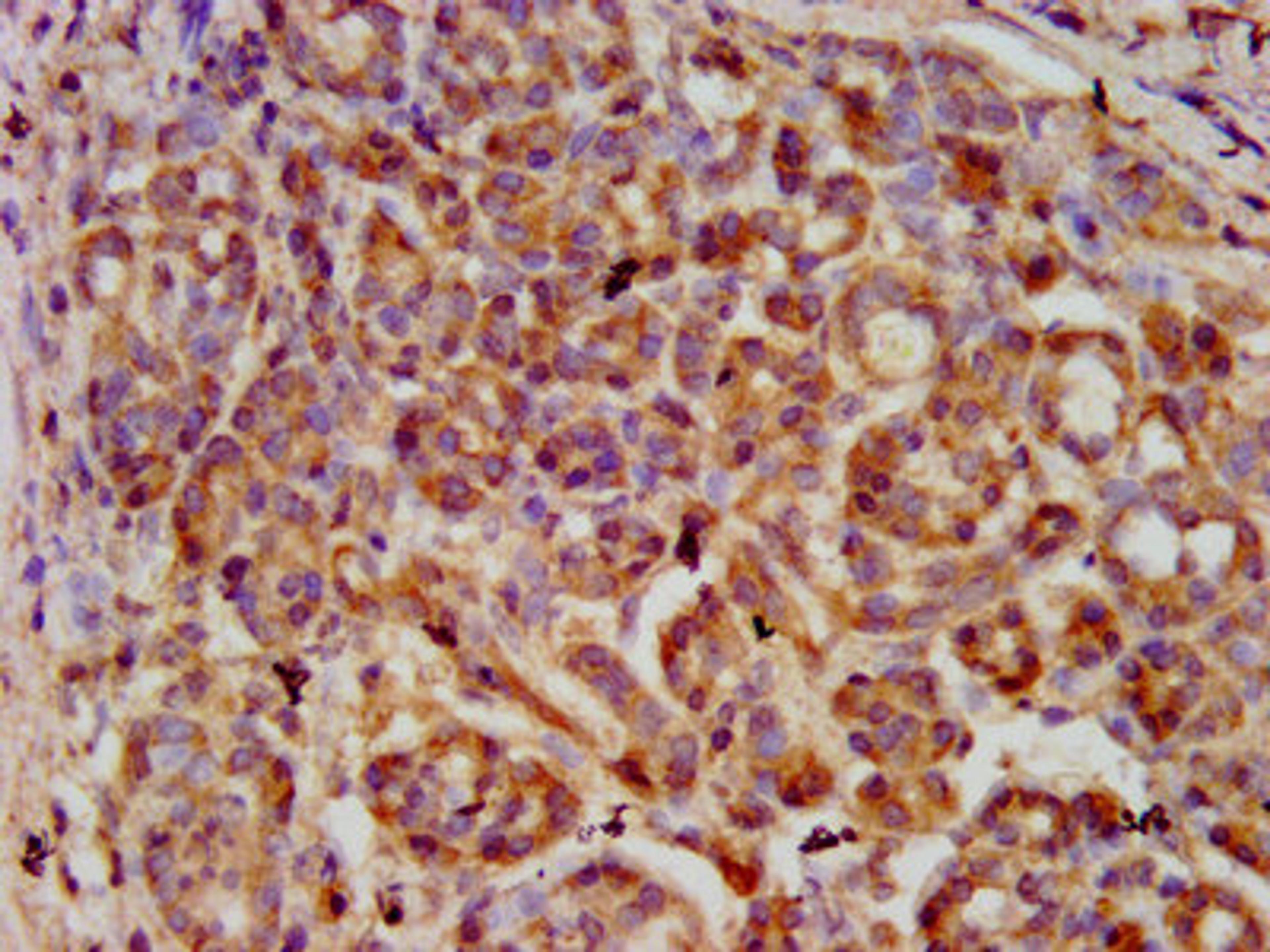 IHC image of CSB-PA021072LA01HU diluted at 1:600 and staining in paraffin-embedded human pancreatic cancer performed on a Leica BondTM system. After dewaxing and hydration, antigen retrieval was mediated by high pressure in a citrate buffer (pH 6.0). Section was blocked with 10% normal goat serum 30min at RT. Then primary antibody (1% BSA) was incubated at 4&deg;C overnight. The primary is detected by a biotinylated secondary antibody and visualized using an HRP conjugated SP system.