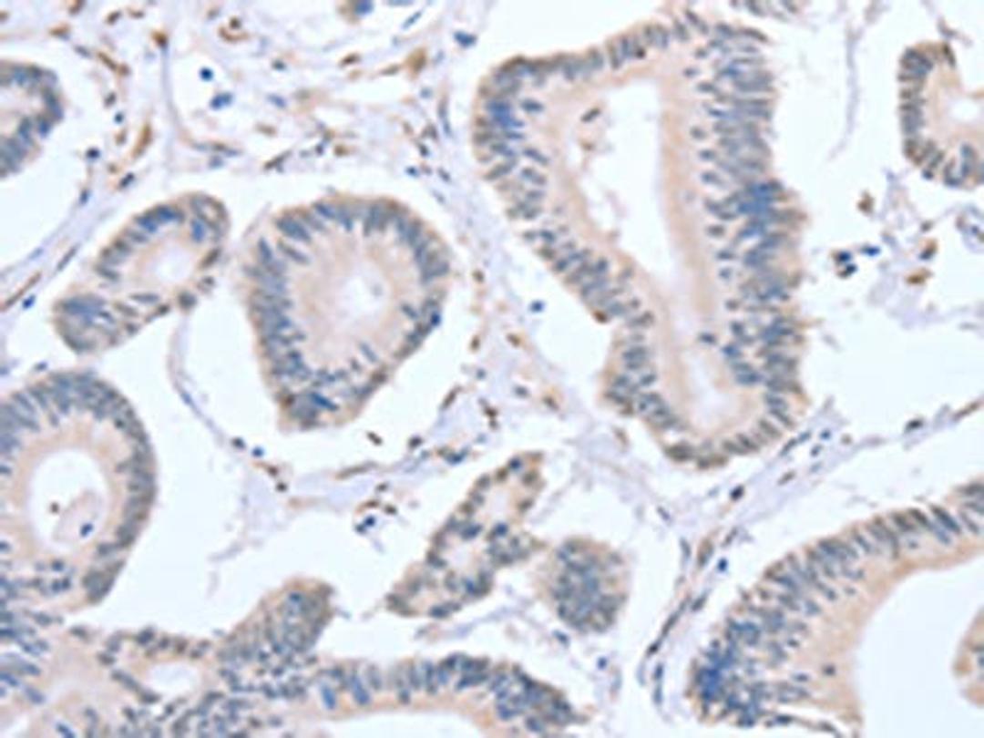 The image on the left is immunohistochemistry of paraffin-embedded Human colon cancer tissue using CSB-PA242845(APEX1 Antibody) at dilution 1/20, on the right is treated with fusion protein. (Original magnification: ×200)