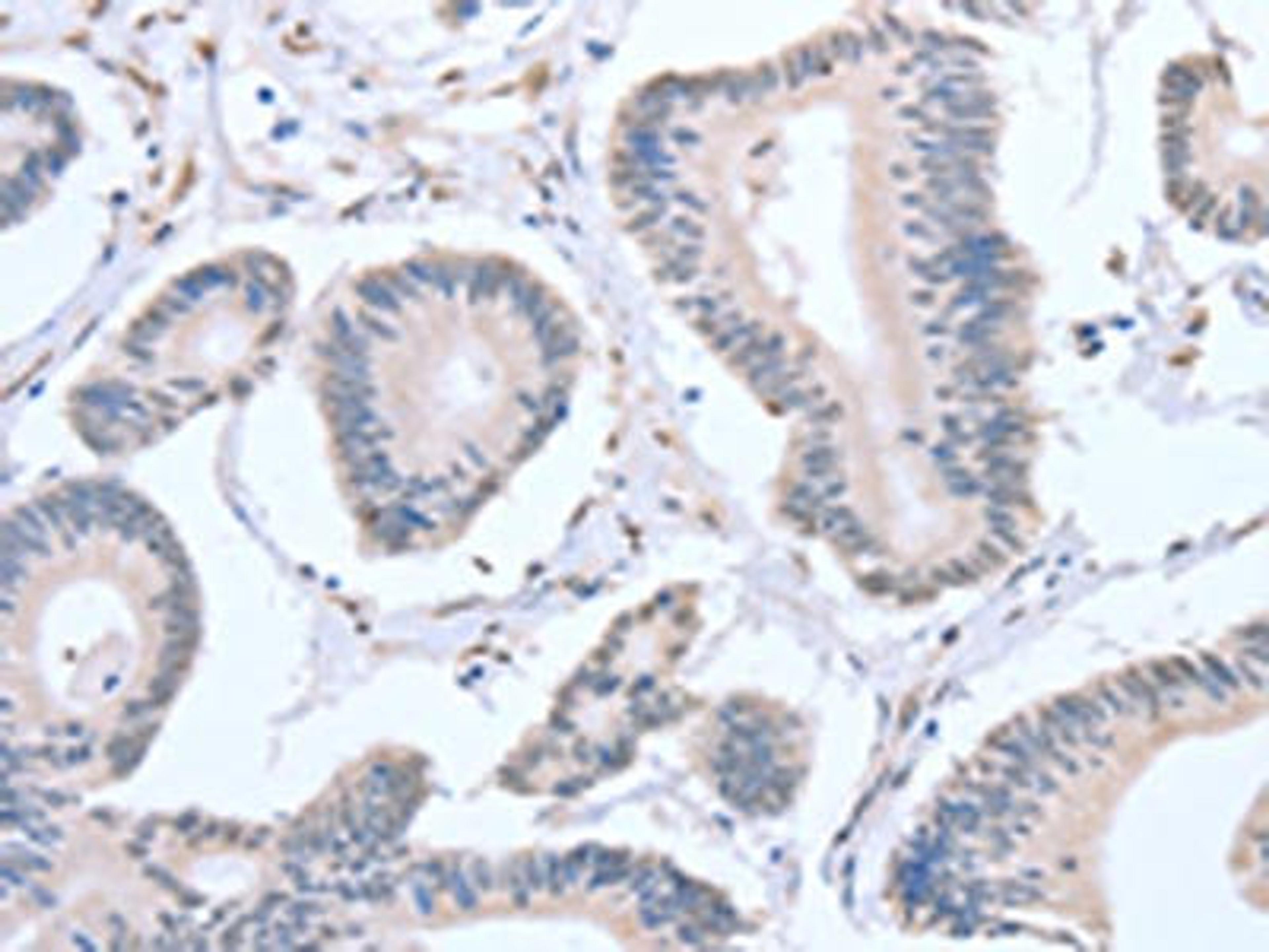 The image on the left is immunohistochemistry of paraffin-embedded Human colon cancer tissue using CSB-PA242845(APEX1 Antibody) at dilution 1/20, on the right is treated with fusion protein. (Original magnification: ×200)