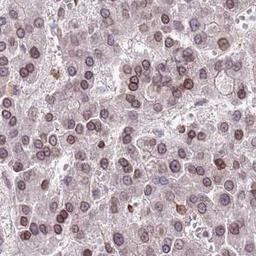 Immunohistochemistry: TMEM47 Antibody [NBP2-32046] - liver cancer