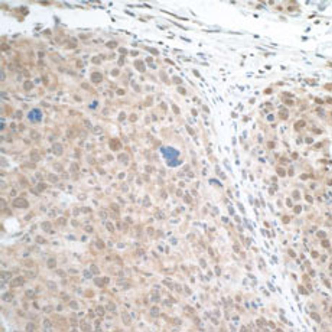 Detection of mouse STAT3 in FFPE renal cell carcinoma by IHC.