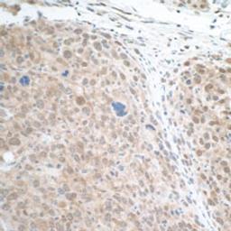 Detection of mouse STAT3 in FFPE renal cell carcinoma by IHC.