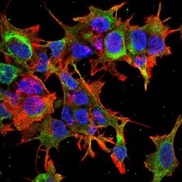 Immunofluorescence analysis of neuroblastoma cell line sk-n-be using GFAP R416WT antibody