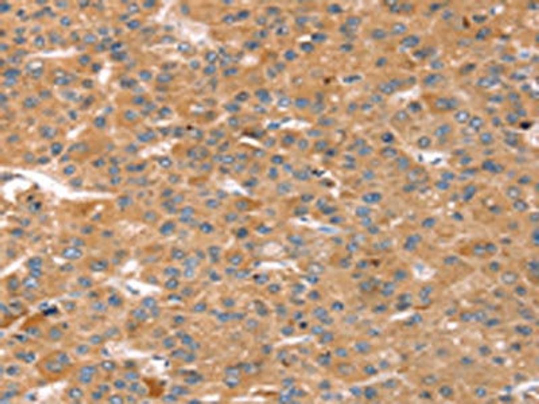 The image on the left is immunohistochemistry of paraffin-embedded Human liver cancer tissue using CSB-PA346002(CAPN7 Antibody) at dilution 1/20, on the right is treated with fusion protein. (Original magnification: ×200)
